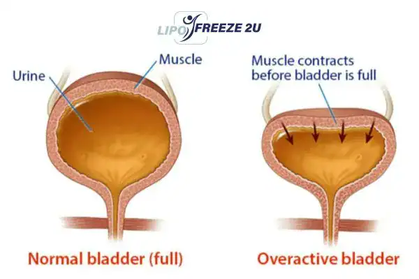 diagram of overactive bladder treatment Herefordshire