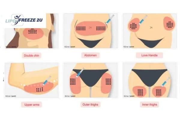Benefits of Choosing Aqualyx for Fat Reduction Herefordshire