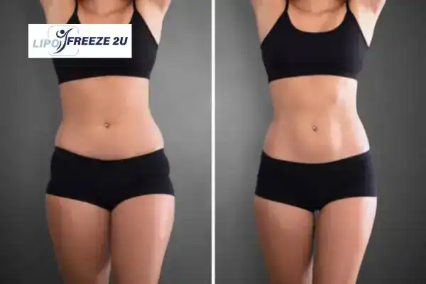 How Can LIPO FREEZE 2U Support Your Post-Pregnancy Body Recovery Herefordshire?