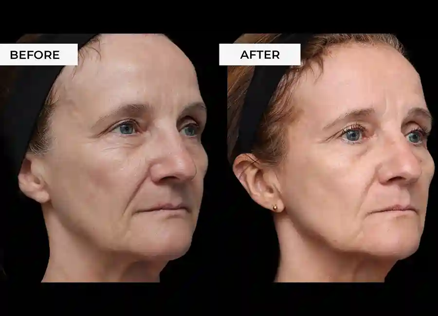 How Many RF Microneedling Sessions Will You Need to See a Difference Herefordshire?