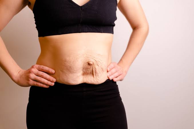 Is Surgery Really the Only Way to Repair Diastasis Recti Herefordshire?