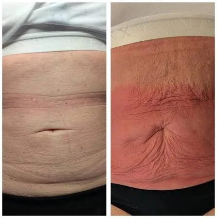 How Does RF Microneedling Improve Crepey, Thin and Uneven Skin Texture Herefordshire?