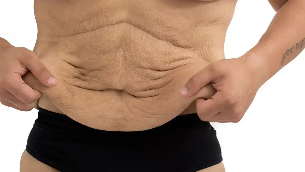 Why Does Weight Loss Medication Leave Some People With Loose or Sagging Skin Herefordshire?